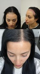 Transplantácia vlasov - Evia Clinic
