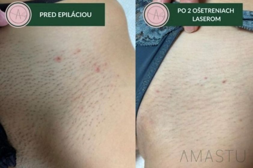Laserová epilácia pred a po - 824188