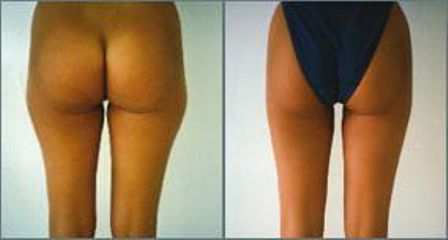 liposukce1