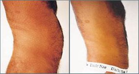lipo3