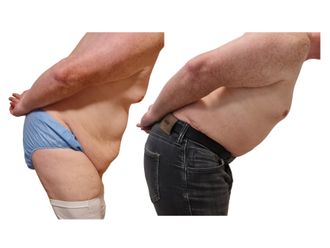 Abdominoplastika pred a po - 873562