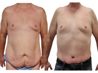 Abdominoplastika pred a po - 873563