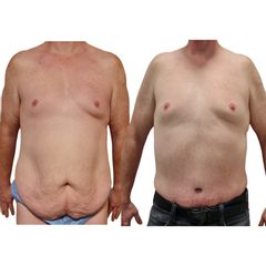 abdominoplastika AESTHETICA