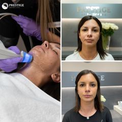 Kyselina hyalurónová - PrestigeClinic