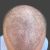 NESTORY - Transplantácia vlasov