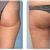 Liposukcia stehien v Interklinik