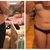 Laserova liposukcia - 2 mesiace po zákroku foto