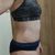 Diastaza a abdominoplastika