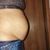 Diastaza a abdominoplastika