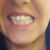 Krivé zuby - aké mám možnosti? 
