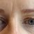 Úprava očných viečok, výsledok po dvoch mesiacoch
