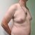 operacia gynekomastie Euroclinic Trnava u dr.Bumberu. 10.2.2022