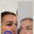 Nitovy lifting a botulotoxin