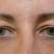Operácia očných viečok-Blepharoplastika, MUDr. Ján Bumbera, Euroclinic Trnava, som veľmi spokojná, odporúčam 