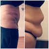 Kombinovaný zákrok korekcia diastazy + abdominoplastika 