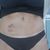 Abdominoplastika - úžasný rozdiel