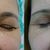 Blefaroplastika, MUDr. Škulavíková