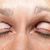 Operácia očných viečok-Blepharoplastika, MUDr. Ján Bumbera, Euroclinic Trnava, výborná práca, výsledok je perfektný 