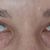 Operácia očných viečok-Blepharoplastika, MUDr. Ján Bumbera, Euroclinic Trnava, výborná práca, výsledok je perfektný 