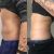 CoolSculpting spodného brucha