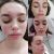 Liečba akné v Scarlett clinic, Košice, Drakula terapia, chemický peeling, bezchybná pleť, odporúčam každému