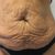  Abdominoplastika - profesionálny prístup MUDr. Hedera, Concept Clinic