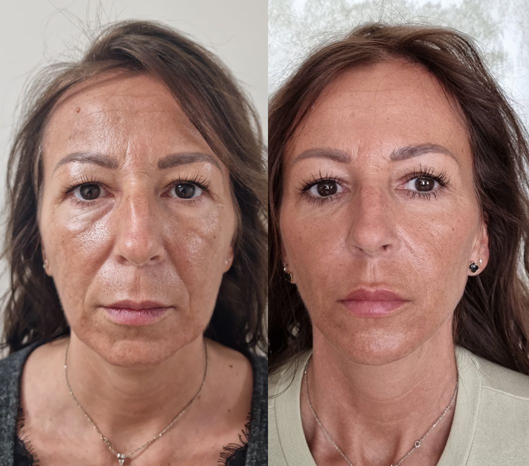 Endolift laser lifting tváre Facelift Estheticon.sk