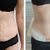 Abdominoplastika bricha v Avelane Clinic