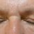 Operácia očných viečok-Blepharoplastika, MUDr. Ján Bumbera, Euroclinic Trnava, som nad mieru spokojná, odborníka som si vybrala správne