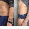 CoolSculpting spodného brucha