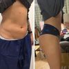 CoolSculpting spodného brucha