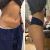 CoolSculpting spodného brucha
