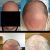 Transplantace vlasů v červnu 2017 u MUDr. Nestorové