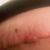 abdominoplastika brucha
