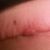 abdominoplastika brucha
