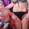 Jazva po Abdominoplastike