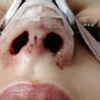 Asymetrické nosné dierky po rhinoplastike