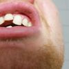 Krivé predné zuby-korunky, fazety alebo iná možnosť ako strojček? 