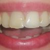 Predkus predného zubu, sú vhodné fazety? 