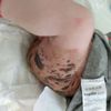 Neurokutaná melanóza-vie niekto viac o diagnóze? Hľadám lekára