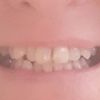 Fazety na krivé zuby, je to pre mňa vhodná voľba?