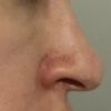 Operácia nosa-Rhinoplastika-špička nosa, nesymetrické nosné dierky