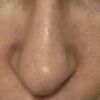 Operácia nosa-Rhinoplastika-špička nosa, nesymetrické nosné dierky