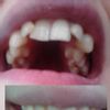 Zbrúsenie krivých zubov a korunky