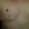 Vpadnuté bradavky po operácii gynekomastie