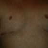 Vpadnuté bradavky po operácii gynekomastie