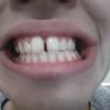 Medzierka medzi prednými zubami