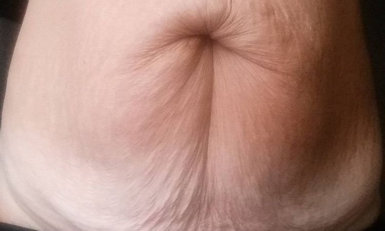 abdominoplastika - ísť do toho? - 45958