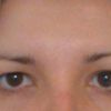 Operácia očných viečok - Asimetria očí - 45960