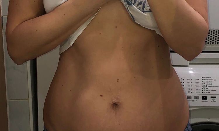 Liposukcia/abdominoplastika - 45988